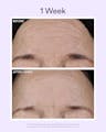 One-week before-and-after images demonstrating visible smoothing of forehead lines