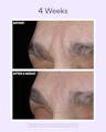 Four-week before-and-after images showing reduction in deep forehead wrinkles