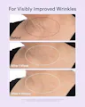 Before and after comparison of visibly improved wrinkles on a person's neck.