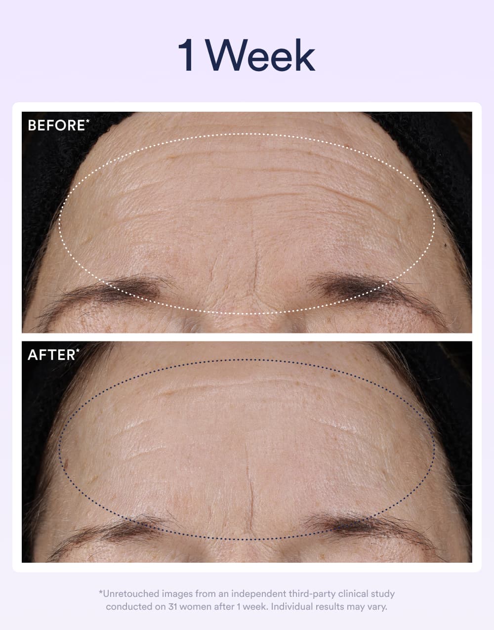 Before and after results showing wrinkle reduction after 1 week
