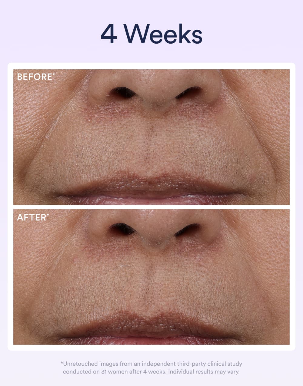 Before and after results showing reduced lines after 4 weeks