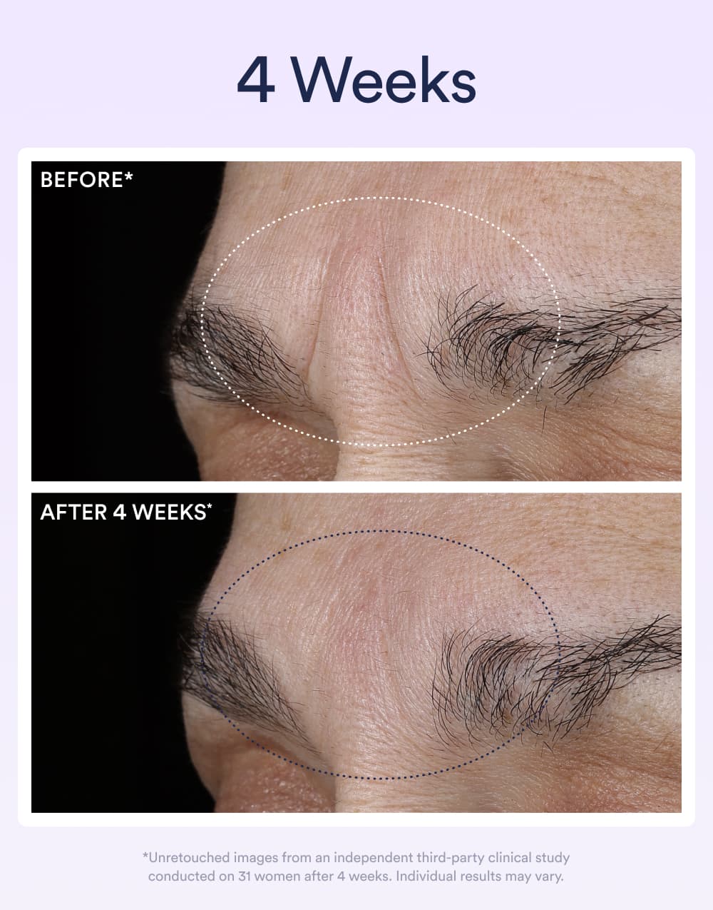 Before and after comparison of skin texture on a forehead with text indicating a 4-week period.